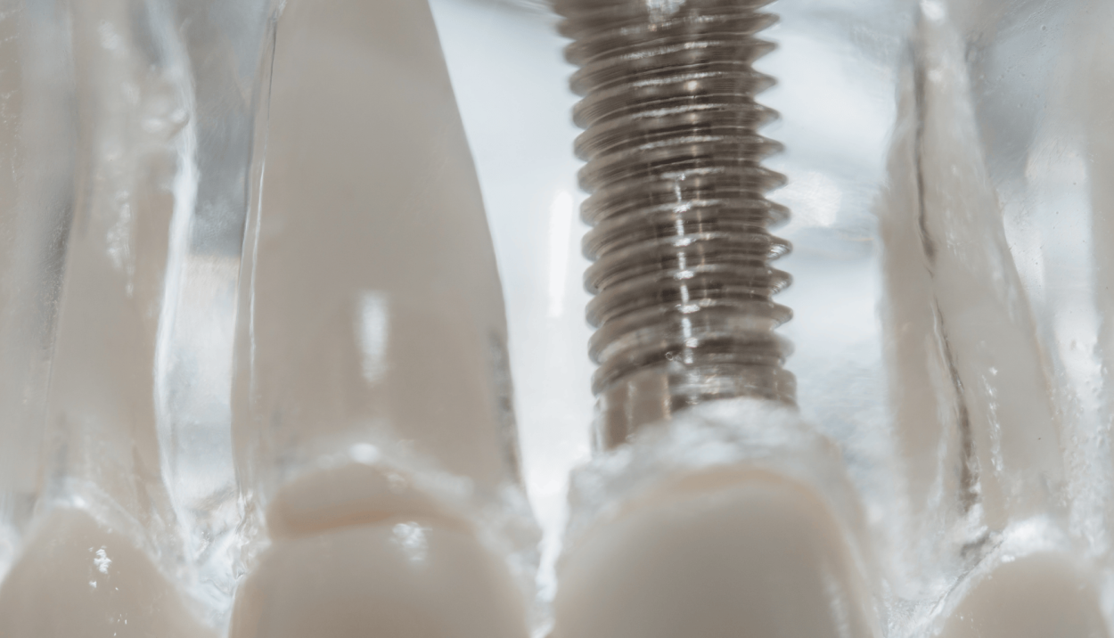 dental implants at darren bywater